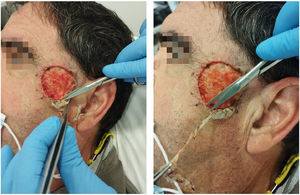 Dressing procedure step: trimming the loose edges of the Biobrane®.