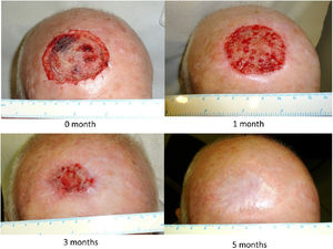 Progression of a scalp wound until complete healing.