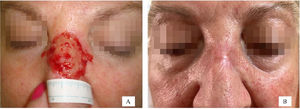 (A) Pre- and (B) postoperative images of the nose.