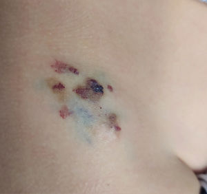 Imagen clínica. Tumor localizado en la región ilíaca derecha, compuesto de agregados dispersos de vesículas de color amarillento translúcido, rojizas y de color rojizo oscuro, así como pápulas.