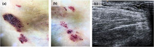 Dermatoscopia e imágenes ecográficas. (a) La dermatoscopia de las vesículas de color rojizo oscuro mostró lagunas de color rojo oscuro/azuladas. (b) La dermatoscopia de las vesículas translúcidas reflejó lagunas de color marrón claro rodeadas de septos más pálidos, zonas rojizas focales y características de tipo hipopión. (c) La ecografía Doppler reveló un ligero engrosamiento de 3mm de tejido subcutáneo, compuesto de estructuras quísticas milimétricas sin señal Doppler en su interior, consistente con una malformación vascular de crecimiento lento.