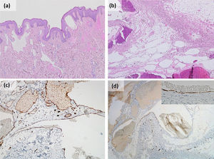 El examen histológico reveló la presencia de una proliferación vascular benigna compuesta de canales vasculares dilatados irregulares de tamaño variable en la dermis e hipodermis. Las estructuras vasculares son principalmente canales revestidos de endotelio fino (c) positivas para CD31 y focalmente positivas para (d) podoplanina D2-40 sin estroma de soporte. (a y b) Hematoxilina y eosina, amplificación original (a) 40×; (b) 100×; (c) CD31 100×; (d) podoplanina D2-40 100×.