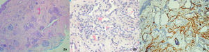 Pathology: (a) “Cannonball pattern” (H&E, ×4); (b) Proliferation of spindle-shaped cells forming solid islands in deeper layers (H&E, ×40); (c) Immunohistochemistry D2-40: positive.