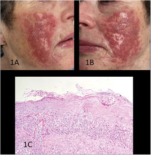 A-B) Clinical images prior to diagnosis. Plaques formed by erythematous papules with slight superficial scaling, with some pustules over an erythematous base. C) Histological study using hematoxylin-eosin staining revealing an acanthotic epidermis with spongiosis, aggregates of intracorneal neutrophils, hyphae, and fungal spores in the stratum corneum positive to PAS staining, and a dense band-like lymphoplasmacytic infiltrate in the underlying dermis.