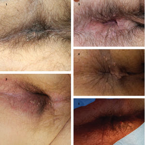 Patients with grouped perianal comedones. Open comedones with black keratin plugs and closed comedones can be seen.