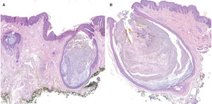 Histopathology (H&E stain); magnification A: ×20, magnification B: ×40. The superficial infundibular portion is slightly dilated and cystic, with mild fibrotic and inflammatory changes in the underlying dermis. These findings are consistent with hidradenitis suppurativa.