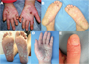 (A) Erythematous–squamous plaque with hemorrhagic crusts and fissures on the palms and fingers of both hands. (B) White-yellowish keratotic plaques on the soles and toes of both feet, with fissures and hemorrhagic crusts. (C) White-yellowish keratotic plaques on the soles extending to the toes, with the presence of fissures. (D) Whitish keratotic plaques on the palms and fingers, with fissures and hemorrhagic crusts. (E) Erythematous-desquamative plaque on the distal region of the first finger of the left hand, with fissures and periungual and nail involvement (discoloration, longitudinal ridges, pitting, and nail dystrophy).