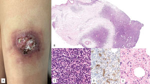 EBV+ mucocutaneous ulcer (EBV+-MCU). (A) Clinical image showing an isolated ulcer with necrotic areas and surrounding erythema located on the anterior aspect of the left thigh. (B) At low magnification, a dermal infiltrate with intense involvement of the deep portion and a nodular pattern is observed (H&E, 2×). (C) At higher magnification, the infiltrate is heterogeneous, with atypical elements of Sternberg-like habit (H&E, 20x). (D) Part of the infiltrate tests positive for CD30 (20×); and (E) positive for EBER (20×).