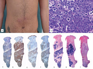 EBV+ extracavitary PEL. (A) Clinical image showing a subcutaneous mass with erythema on the periumbilical skin. (B) At higher magnification, the tumor infiltrate consists of large elements with a plasmablastic habit (H&E, 20×). The immunohistochemical study reveals that these cells are (C) negative for CD20 (2×) and (D) negative for CD3 (2×). Conversely, they show positivity for (E) CD138 (2×), (F) HHV8 (2×), and (G) EBER (2×), and (H) monotypic expression for kappa light chains (2×). (I) Lambda light chains (2×).