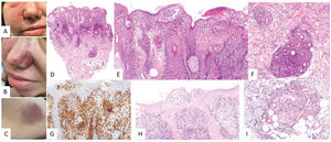 Hydroa vacciniforme-like lymphoproliferative disorder. (A–C) Clinical images of a patient