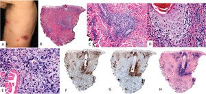 Extranodal NK/T-cell lymphoma. (A) Clinical image shows multiple nodules with necrotic centers and erythematous halos distributed on the trunk. (B) (H&E, 2×): At low magnification, a dermal infiltrate is observed in the superficial and deep portions, related to vessels (C, 4×) and adnexa with epidermotropism (D, 10×). At higher magnification (E, 20×), the infiltrate is composed of large atypical elements. These cells are positive for CD3 (F, 2×), CD56 (G, 2×), and EBER (H, 2×).