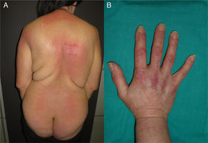 (A) Patient with violaceous rash on the posterior neck, shoulders, and extensor arms. A spared area on the back follows the “angel wings” distribution. A flagellate erythema is visible on the upper back, with superficial cutaneous necrosis on the right scapular area. (B) Typical appearance of the dorsum of the hand in paraneoplastic DM, with erythematous-violaceous papules over the metacarpophalangeal and interphalangeal joints (Gottron