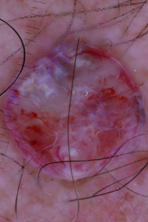 Dermoscopy. A rainbow pattern can be seen in the upper region, red-white areas, hemorrhagic zones in the central part, and small areas of bluish-gray ovoid nests on the right lateral margin.