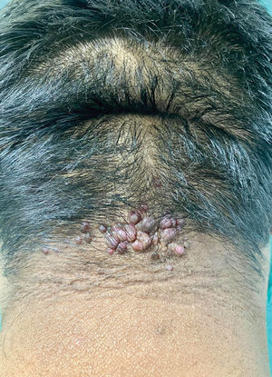 Initial stage of AKN showing fibrotic lesions with a papular and nodular appearance centered on follicles in the nuchal area.