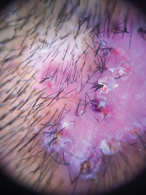 Trichoscopy showing tufted hairs centered on papules and pustules that converge into a scarring alopecia plaque.