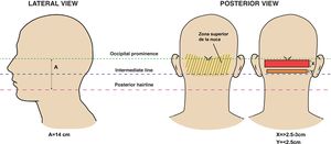 Lateral and posterior views indicating the anatomical references of the nuchal area—upper line demarcated by the occipital protuberance and lower line by the posterior hairline—delineating treatment areas. Figure adapted from Umar et al.28