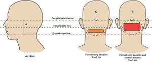 Lateral and posterior views of the head showing reference points for bat-shaped excision alone (a) and with tension sutures. Adapted from Umar et al.30