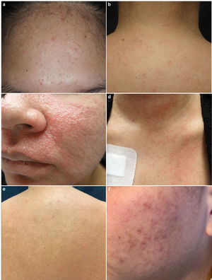 Clinical presentation of demodicosis in patients #1 (a), #2 (b), #3 (c–e) and #4 (f). (a) Small pustular lesions over the forehead. (b) Maculopapular rash and pustules on the upper back. (c) Confluent maculopapular exanthema involving the perioral and malar regions. (d, e) Maculopapular rash and micropustules over chest and back. (f) Malar pustules and erythema.