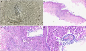 Parasitological test and histopathological images of skin lesions. (a) Parasitological skin test showing DF. (b, c) At lower power, dermatopathology images show a pronounced perifollicular lymphocytic infiltrate around hair follicles (hematoxylin-eosin staining, original magnification (b) ×40 and (c) ×100. (d) High power image showing a tubular structure consistent with DF (hematoxylin–eosin staining, original magnification ×400).