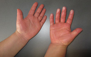 Caso 1: Hiperhidrosis, edema y cianosis acra de la mano derecha.