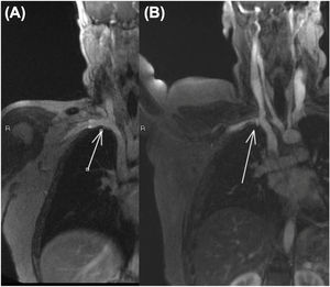 Caso 1: Resonancia magnética dinámica: A: Vena subclavia derecha permeable (flecha) en aducción. B: Vena subclavia derecha comprimida (flecha) con la abducción.