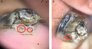 (A) Dermoscopy of the nail free edge: yellowish brown keratotic areas with scales (yellow arrow) and horizontal and vertical fractures (black arrow) arranged in a frogspawn pattern (red circle). (B) Dermoscopy of nail plate: yellowish white irregular discoloration (green arrow).