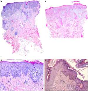 Características histológicas. a. Biopsia de una de las lesiones faciales, presencia de hiperplasia regular/psoriasiforme asociada a paraqueratosis confluyente. Destaca la ausencia de neutrófilos dentro de las capas epidérmicas. Además, se aprecia un infiltrado inflamatorio linfohistiocitario perivascular (paciente 2, H&E, vista panorámica). b y c. Biopsia obtenida del paciente 3, se observan estructuras foliculares dilatadas, mientras que en el paciente 4 se pueden observar claros focos de espongiosis (H&E, ×40). d. La tinción con azul alcián revela la presencia de mucina en la dermis media (paciente 5, ×20). e. Sutil acantólisis subcórnea en la muestra de biopsia del paciente 10 (H&E, ×20).