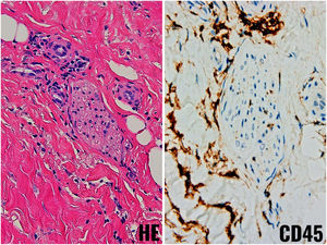 Mild perineural inflammation demonstrated with hematoxylin–eosin (H&E) and pan-lymphocytic immunohistochemistry (CD45). Mild perineural inflammation demonstrated with hematoxylin–eosin (H&E) and pan-lymphocytic immunohistochemistry (CD45).