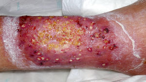 Clinical appearance at emergency department presentation. A warm, erythematous–edematous plaque with MP central necrotic ulcers involving the right leg in a semicircumferential pattern. Clinical appearance at emergency department presentation. A warm, erythematous–edematous plaque with MP central necrotic ulcers involving the right leg in a semicircumferential pattern.