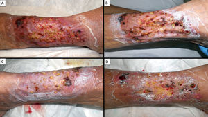 Clinical evolution of the lesion. Daily wound care consisted of wet compresses with zinc, copper, and aluminum–potassium sulfates, followed by careful mechanical debridement of necrotic tissue and application of collagenase to remaining slough. Islands of spared and surrounding skin were protected with a barrier cream containing copper and zinc sulfate, then covered with a silver alginate dressing and bandage. Clinical appearance at 48h (A) and 96h (B) after initiation of the comprehensive approach shows clear improvement in erythema, edema, and ulceration. By day 5 (C) the response remained favorable and progressive. At day 10 (D), re-epithelialization was evident both concentrically from lesion borders and eccentrically from islands of spared skin inward over debrided areas. Clinical evolution of the lesion. Daily wound care consisted of wet compresses with zinc, copper, and aluminum–potassium sulfates, followed by careful mechanical debridement of necrotic tissue and application of collagenase to remaining slough. Islands of spared and surrounding skin were protected with a barrier cream containing copper and zinc sulfate, then covered with a silver alginate dressing and bandage. Clinical appearance at 48h (A) and 96h (B) after initiation of the comprehensive approach shows clear improvement in erythema, edema, and ulceration. By day 5 (C) the response remained favorable and progressive. At day 10 (D), re-epithelialization was evident both concentrically from lesion borders and eccentrically from islands of spared skin inward over debrided areas.