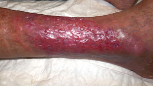 Clinical appearance at 1 month of treatment. Complete re-epithelialization of the entire lesion without signs of ulceration or necrosis. Clinical appearance at 1 month of treatment. Complete re-epithelialization of the entire lesion without signs of ulceration or necrosis.