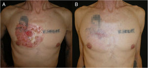(A) Day 1 of treatment with sonidegib 200mg on alternate days. The lesion consisted of a 4×4-cm central ulcer surrounded by a 13×10-cm infiltrative plaque on the right pectoral region. (B) Clinical response 8 months into sonidegib 200mg on alternate days.