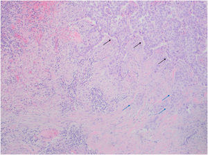 Hematoxylin–eosin, 4×. Low-power view from one margin of the ulcer showing basaloid tumor areas (black arrows) and epithelioid nests (blue arrows). The latter predominate toward the center of the ulcer.