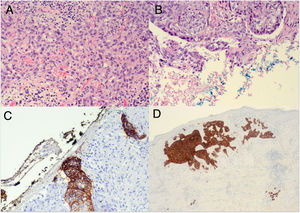 Histopathology of the central ulcer. (A) Hematoxylin–eosin, 40×: squamous differentiation, predominant in central ulcer sections. (B) Hematoxylin–eosin, 40×: basaloid differentiation with peripheral palisading and clefting near the resection margins. (C) Ber-Ep4, 4×: strong positivity in BCC areas and negativity in regions of squamous differentiation. (D) Ber-Ep4, 4×: section from an ulcer margin showing Ber-Ep4–positive basaloid cells and Ber-Ep4-negative squamous cells.