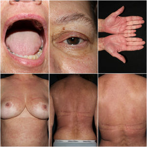 Photos after 1 month of treatment. Remarkable improvement in cutaneous and mucosal lesions without sequelae.