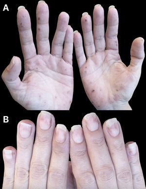 Violet papules with a central crust. Also prominent are brownish umbilicated residual macules and papules. All lesions are located on the palms, fingers, and dorsal hands (A). Onycholysis can be observed in almost all nails, along with brownish subungual speckling (B).