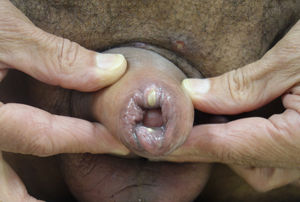 Patient #2. Foreskin edema and pseudopustules on its free margin and on the pubis.