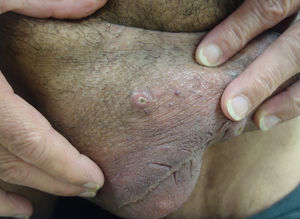 Patient #2. Detail of another pseudopustule on the scrotum in the same patient.