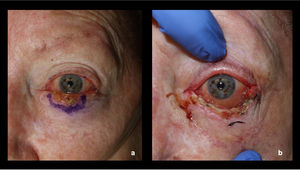 (a) Clinical image of a 12mm×5mm keratotic lesion corresponding to squamous cell carcinoma in situ involving the eyelid margin. (b) Resulting defect after 2 stages of Mohs surgery.