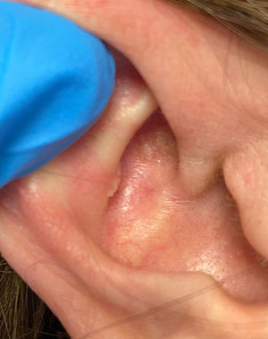 Clinical image: multiple papules on the right auricular concha.