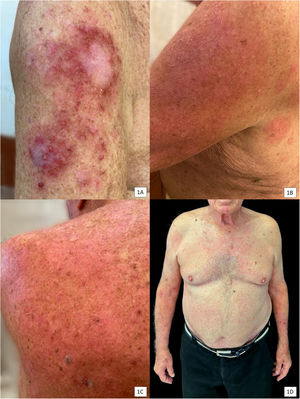 Local reaction to imiquimod application sites 5 weeks into therapy (A). Eczematiform lesions in the contralateral arm (B) and trunk (C) also 5 weeks into therapy. Persistence of eczema 12 months after finishing therapy (D).