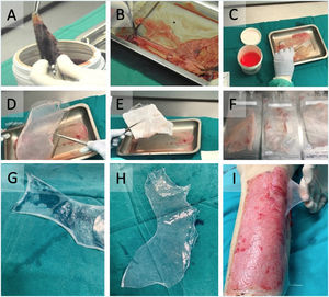 Processing and application of the human AM grafting. Panels A through F sequentially illustrate the processing steps leading to preparation of the sample (panels G and H). Panel I shows placement of the amniotic membrane in a separate patient with a burn-related defect.