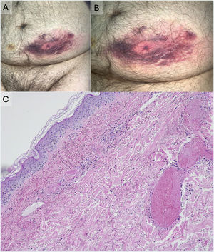 Clinical presentation and histopathological examination of the lesion. (A and B) 12cm×8cm erythematous-purple plaque in the left iliac fossa measuring, with well-demarcated borders, and contusion-like appearance. (C) Dermal thrombosis, with incipient dermal necrosis and abundant hemorrhagic extravasation (Hematoxylin–eosin, 8×).