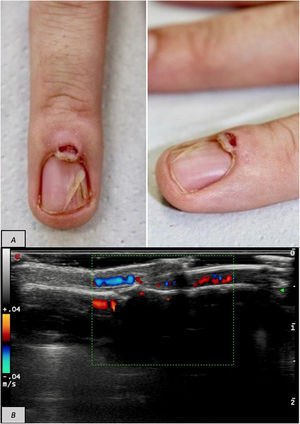 (A) Ectopic nail emerging from a skin-colored papule on the proximal nail fold, with onycholysis of the medial nail plate and multiple splinter hemorrhages. (B) Ultrasound with 18-MHz probe: elongated 3-mm lesion on the dorsum of the distal interphalangeal joint, without connection to the matrix and without internal Doppler flow.