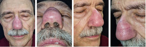 Erythema and soft-tissue enlargement of the nasal dorsum.