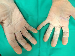 Pseudomonas aeruginosa infection of the hands. Cutaneous maceration and multiple rounded (“moth-eaten”), highly painful ulcers on both hands, with a 1-month duration. The patient had prolonged daily exposure of the hands to water.