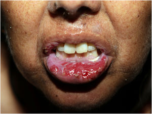 Erosions on the lower labial mucosa.