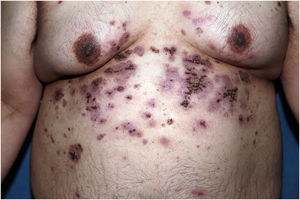 Erosions covered by adherent hemorrhagic crusts alternating with residual macules.