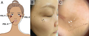 Facial pigmentary demarcation lines. (A) Diagram illustrating the location of the lines. (B, C) Asian patient with type G lines (black arrows), forming a “W” shape at the lateral canthus of the right eye. Dermoscopy showed accentuation of the facial pseudoreticular pattern (white arrows) and a granular white pattern (white arrowheads).