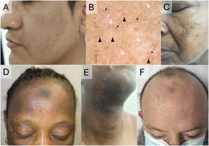 (A, B) Melasma in a 42-year-old Latin American man. (A) Irregular brown macules with areas of spared skin, predominantly on the cheeks. (B) Dermoscopy shows a prominent pseudoreticular pattern (black arrows), arcuate structures (black arrowheads), and lighter areas of spared skin (white arrows). Note the preservation of follicular units (white arrowheads). (C) Melasma on the cheek of a Latin American patient. (D) Post-inflammatory hyperpigmentation in a woman of African ancestry, with brown macules on the forehead and eyelids secondary to atopic dermatitis. (E) Post-inflammatory hyperpigmentation in a young man due to beard folliculitis. (F) Frontal post-inflammatory hyperpigmentation secondary to prayer in a Muslim man.